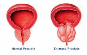 Prostate Aging